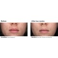 23375-acne-gel-bna-1_2.jpg