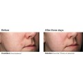 23375-acne-gel-bna-2_2.jpg