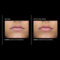 hyaluronic-acid--lip-booster.jpg